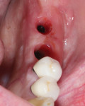 Six-month postoperative occlusal view of the final softtissue profile demonstrating an abundance of attached gingiva on the buccal and lingual aspects.