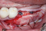 The native keratinized gingiva was mobilized and repositioned toward the lingual aspect, and a vestibuloplasty procedure was completed on the buccal aspect to apically reposition the mucosa.