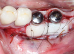 A free gingival graft was sutured buccal to the healing abutments prior to closure.