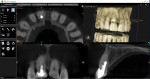 Preoperative CBCT scan of tooth No. 8 showing a long post that extends near to the palatal edge of the root where an open fistula was present.