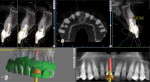 CBCT and intraoral scan data were used to digitally plan an implant-supported restoration to replace tooth No. 8.