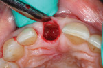 A partial extraction therapy kit was used to section the root of tooth No. 8 to the apex and remove the palatal portion, leaving the remaining “shield” attached to the buccal plate.