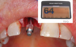 Resonance frequency analysis was performed, which revealed that the implant’s initial ISQ was 64.