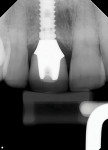 Postoperative radiograph taken to verify the seating of the final crown.