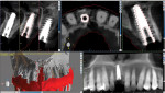 The digital image of the planned implant position (outlined in red) overlayed over the postoperative CBCT scan demonstrates the accuracy of the actual final implant position achieved using the in-office 3D printed surgical guide. Note the root shield as well
as the grafted space between the root shield and the implant.