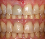 Before (above) and after (below) retracted photographs demonstrating that the postoperative gingival architecture was for all intents and purposes identical to the preoperative gingival architecture.