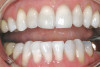 Figure 4  Advanced NCLTS from bruxism, maxillary arch.