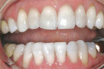 Figure 6  Posttreatment view after a 35% hydrogen peroxide (Sapphire Crystal with Sapphire In-office) was reapplied three times in a single visit with light-enhanced bleaching.