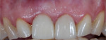Fig 18. Permanent ceramic restorations placed, Nos. 8 and 9.