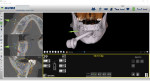 Fig 1. The virtual treatment plan is shown in dynamic navigation software.