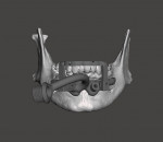 Fig 2. A CAD screenshot shows the occlusal positioning jig and foundation guide seated on the mandible.