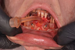Fig 3. The intraoperative view of the occlusal positioning jig and foundation guide seated on the mandible.