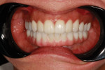Fig 11. An intraoral view showing the inserted final lower prosthesis and the maxillary zirconia restorations.