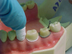 Figure 4  Comprecap retraction cap pressed over a prepared premolar (left). A twisted retraction cord (center) and a braided retraction cord (right) placed around prepared molars. Each cord was then packed into the sulcus with a cord-packing instrume