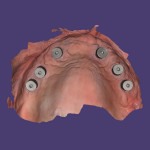 Fig 1. Utilizing photogrammetry to create a CAD file for accurate fabrication of screw-retained full-arch restorations.