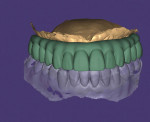 Fig 2. Utilizing photogrammetry to create a CAD file for accurate fabrication of screw-retained full-arch restorations.