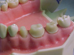 Figure 5   After gingival retraction materials are removed, gingival tissues appear retracted, allowing better access to the sulcus for making a final impression.