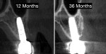 Fig 8. CBCT images at 12 months (left) and 36 months (right). Note additional bone thickness compared to what was clinically observed at the time of second stage-implant surgery. Further maturation and mineralization of DAS was observed at 36 months.