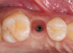 Fig 10. Upon removal of screw-retained crown after 3 years, additional soft-tissue maturation was confirmed.