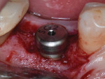 Fig 12. Tissue-level dental implant was placed in a single-stage manner. Buccal bone was thin (<2 mm thickness).