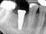 Fig 13. Radiograph at time of implant placement.
