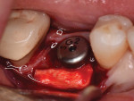 Fig 14. DAS was trimmed, gently hydrated in saline, and folded prior to placement, then adapted over thin buccal bone at the level of the osseous crest.