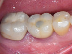 Fig 18. At 1 year after loading, there was sustained peri-implant soft-tissue health and positive buccal ridge contour.