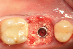 Fig 5. If greater than 2 mm, the gap between the implant and socket walls should be grafted to enhance the healing outcome.
