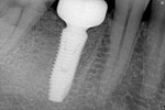 Fig 7. Postoperative periapical radiograph after immediate molar replacement.