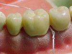 Figure 11  Residual cement can be removed by passing a knotted piece of dental floss through the contacts.