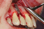 Fig 3. Apex of the dental implant protruding from the osseous envelope.