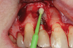 Fig 5. Additional implant decontamination was achieved with topical application of citric acid.
