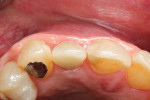 Fig 9. Occlusal view at 24 months demonstrating stable augmentation and peri-implant tissues.