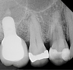 Fig 1. Preoperative radiograph of tooth No. 4 exhibiting periapical radiolucency.