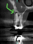 Fig 2. CBCT showing coronal view of tooth No. 4 with periapical radiolucency.
