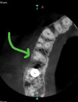 Fig 3. CBCT showing axial view of tooth No. 4 with three roots and three canals.