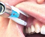 Fig 5. The DentalVibe injection comfort system.