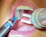 Fig 6. Buccal injection of tooth No. 4 with the DentalVibe.