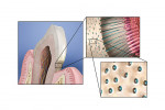 Figure  1   Open dentin tubules create a 