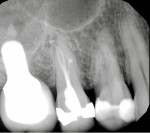 Fig 7. Palatal injection of tooth No. 4 with the DentalVibe.