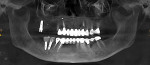 Fig 1. Pretreatment panoramic x-ray showing poor maxillary dentition.
