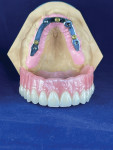 Fig 8. Laboratory-produced final bar and prosthesis (courtesy of David Jackson, CDT, Midsouth Dental Lab).