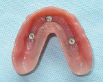 Fig 9. Straumann Novaloc inserts in the intaglio surface of the final prosthesis.