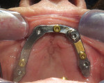 Fig 10. Final custom-made bar with Novaloc abutments in place.