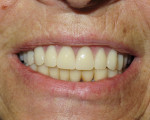 Fig 12. Final smile view.