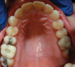 Fig 2. Occlusal view at initial presentation highlighting the erosive wear present on the lingual aspects of the maxillary anterior teeth, with a preserved enamel ring around the gingival margin.