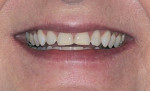 Fig 4. Initial orthodontic situation, showing patient’s relaxed smile with worn incisal edge display.