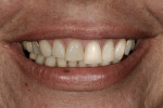 Figure 3  Image of a lower one third smiling exposure that has been digitally altered with Photoshop on the patient’s left maxillary only.