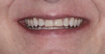 Fig 5. Final orthodontic situation, showing patient’s relaxed smile with leveling of gingival margins and incisal edges.