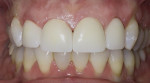 Fig 12. Final maximum intercuspation immediately after delivery of restorations. The restorations had pressed porcelain only from above the incisal edge to the gingival margin. Monolithic zirconia oxide was used for the lingual and incisal edges of the restorations in an effort to prevent chipping.